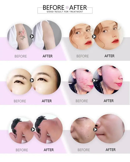 Professional Pico Laser Tattoo Freckle Removal Device 220V